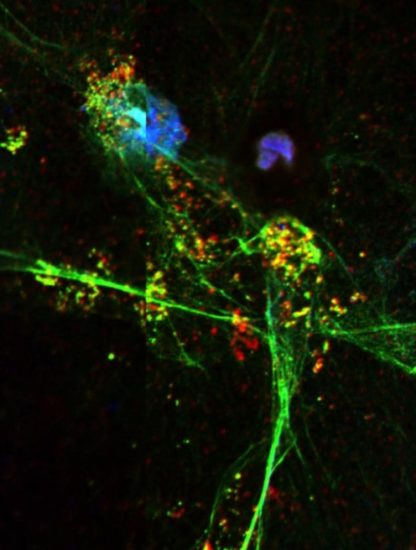 pièges extracellulaires neutrophiles