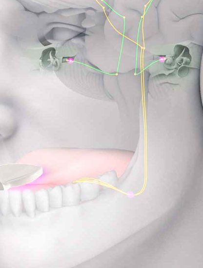 acouphenes traitement musique stimulations langue lenire