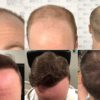 techniques transplantation capillaire dhi fue