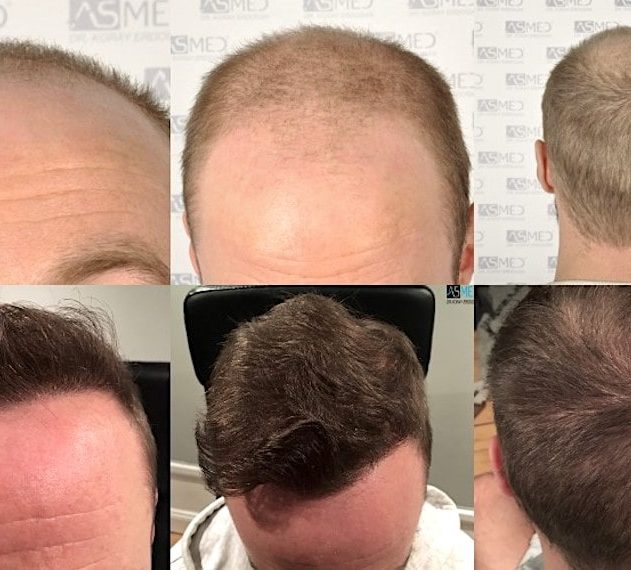techniques transplantation capillaire dhi fue