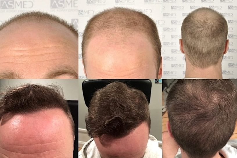techniques transplantation capillaire dhi fue