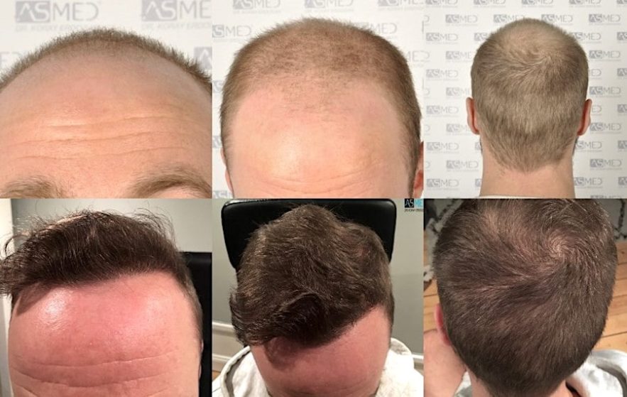 techniques transplantation capillaire dhi fue