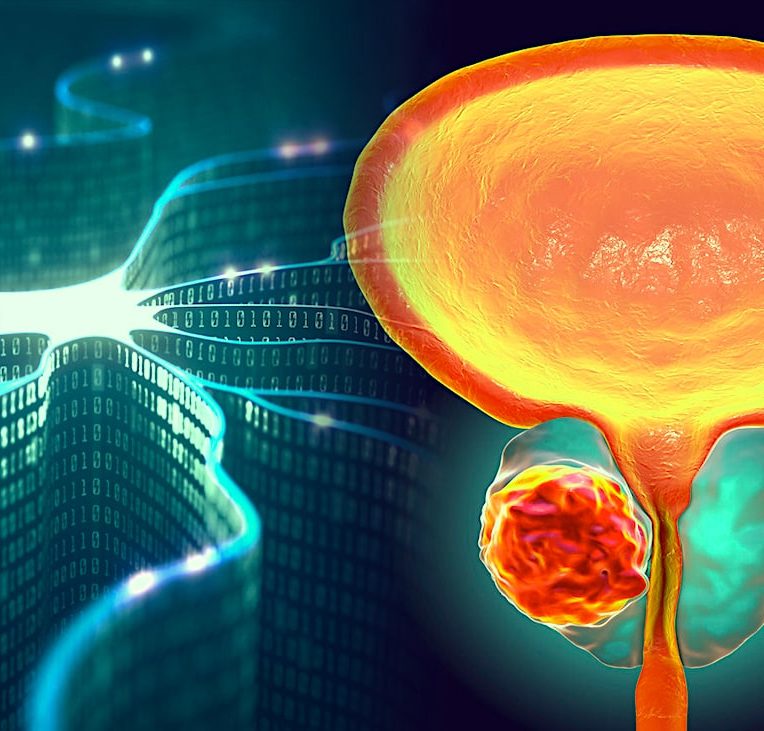 diagnostiquer cancer precision test urine intelligence artificielle
