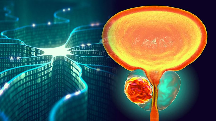 diagnostiquer cancer precision test urine intelligence artificielle