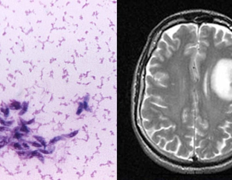 mise evidence lien parasite rapandu cancer cerabral humain