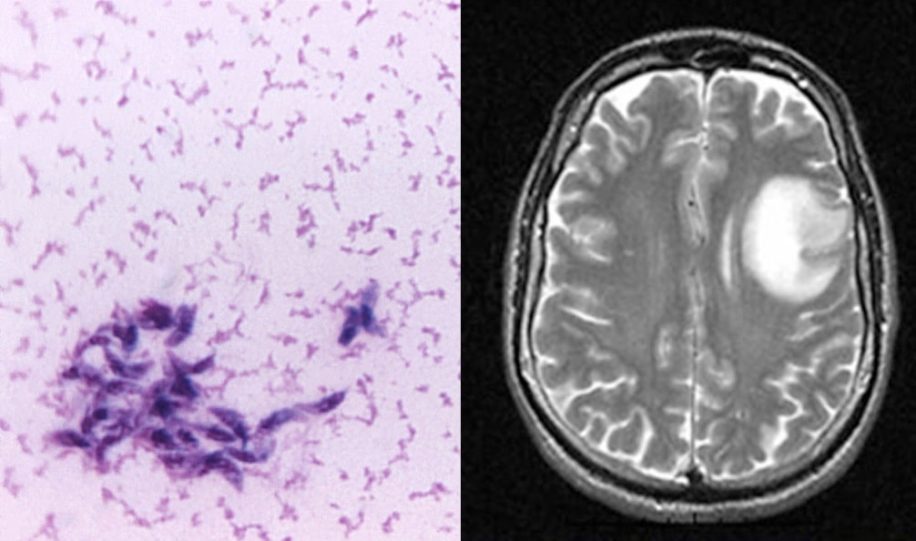 mise evidence lien parasite rapandu cancer cerabral humain