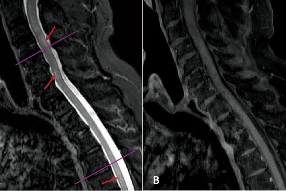 mise evidence lien covid pathologie neurologique rare