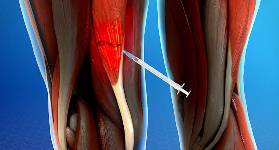 nouvel hydrogel reduit moitie temps recuperation blessures musculaires