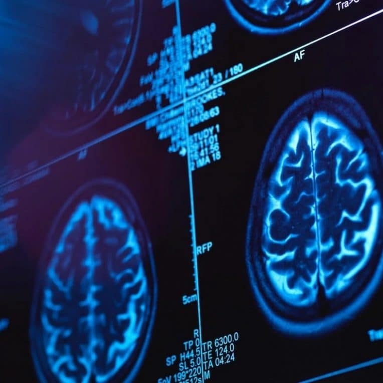 canada medecins enquetent mysterieuse maladie neurologique couv