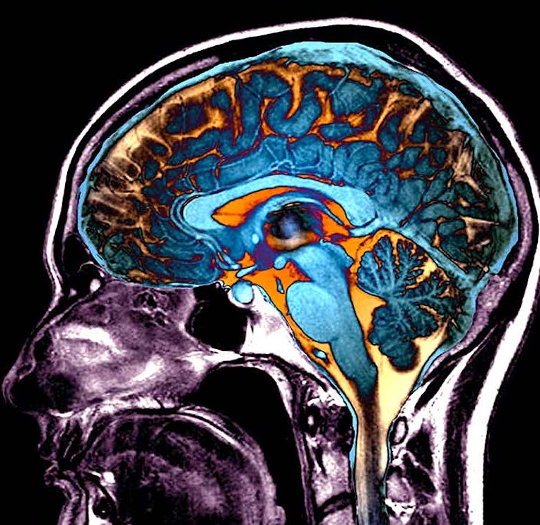 modifications cerebrales provoquees par covid impact sur conscience cognition