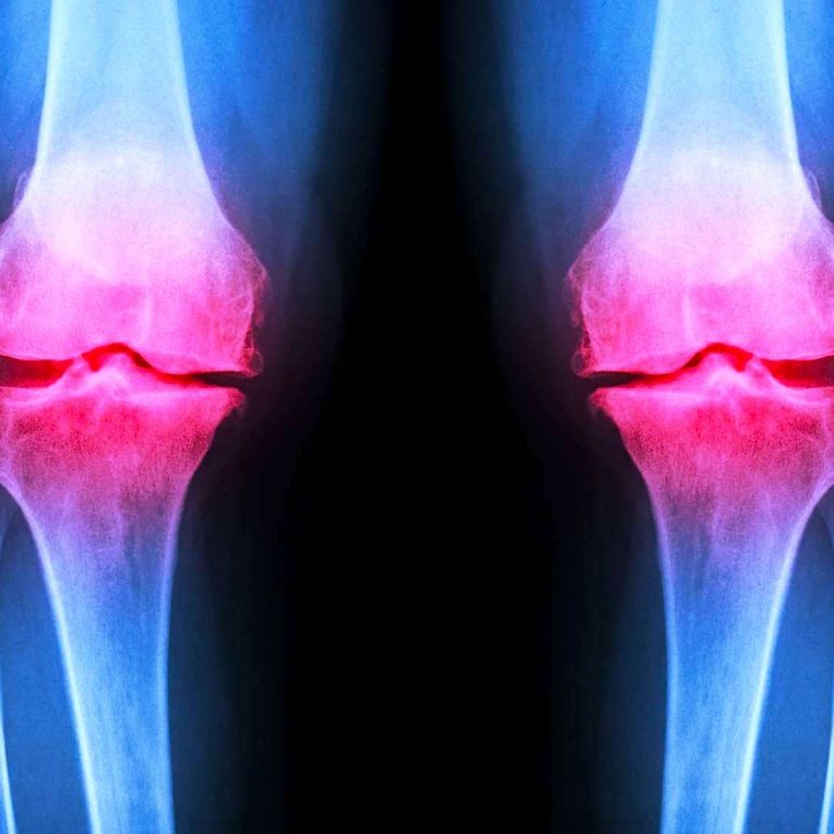 hydrogel injectable regenerer cartilage endommage articulations