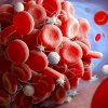 covid long molecules inflammatoires dans microcaillots sanguins