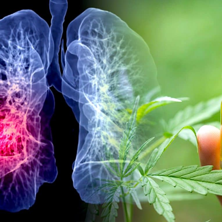 femme taille tumeur regresse avec consommation cbd