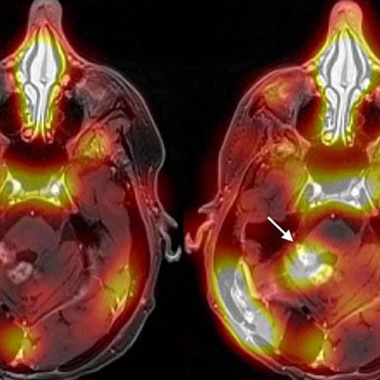 premiere methode-traitement cancer cerveau franchissant barriere hemato-encephalique