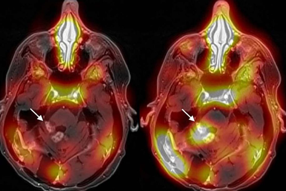 premiere methode-traitement cancer cerveau franchissant barriere hemato-encephalique
