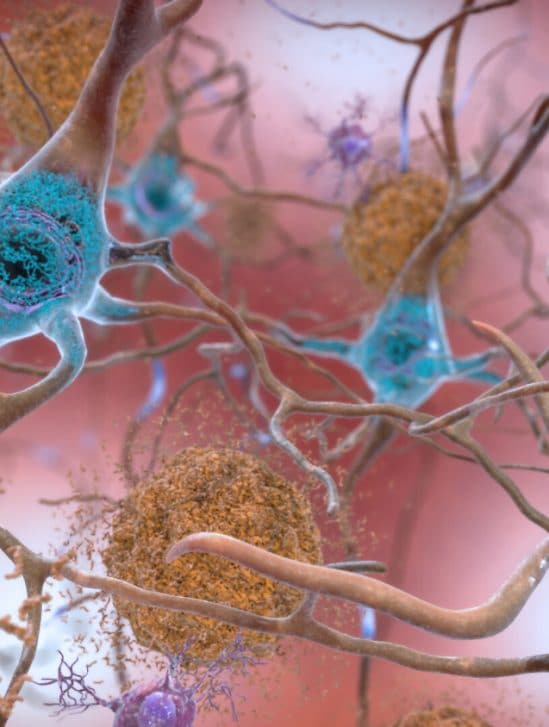 premier essai clinique vaccin alzheimer