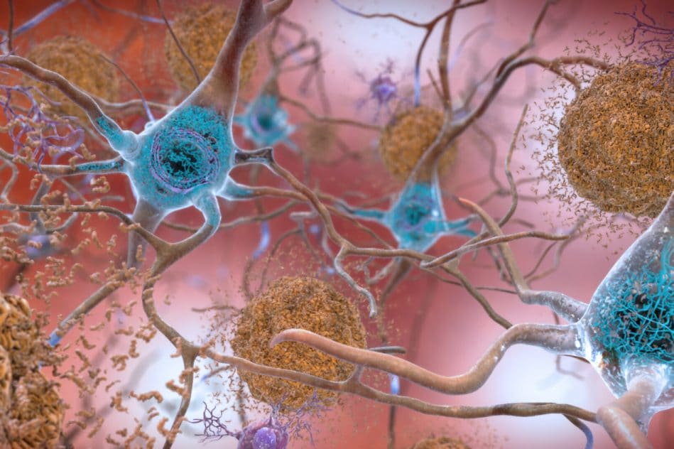 premier essai clinique vaccin alzheimer