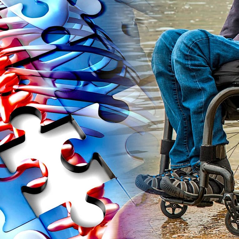 traitement paralysie implants moelle épinière