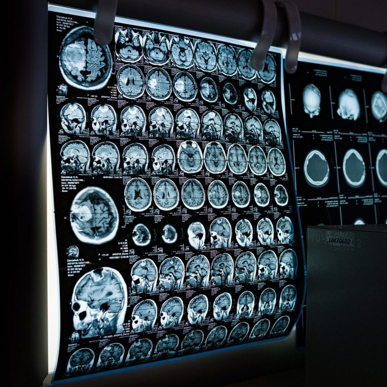 Covid lésion cerveau perte matière grise