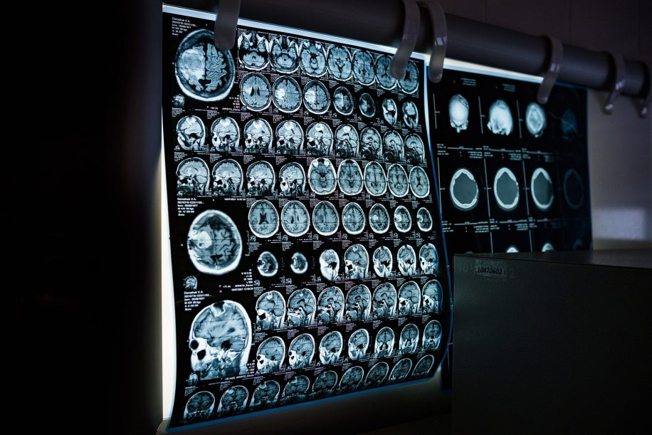 Covid lésion cerveau perte matière grise