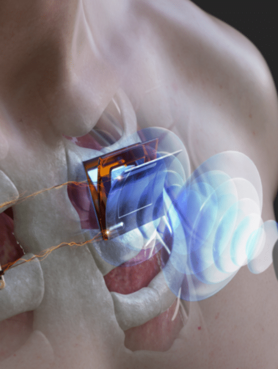 ultrasons recharge implants cardiaques sous marins