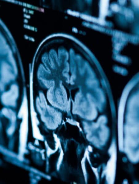 declin cognitif covid long severe vieillissement 20 ans couv