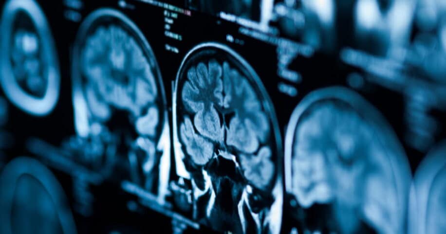 declin cognitif covid long severe vieillissement 20 ans couv