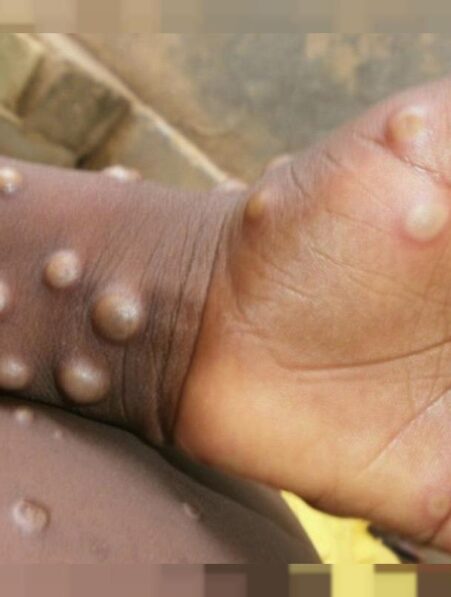 variole singe augmentation nombre cas rapide epidemie