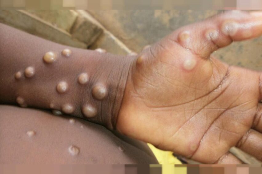 variole singe augmentation nombre cas rapide epidemie