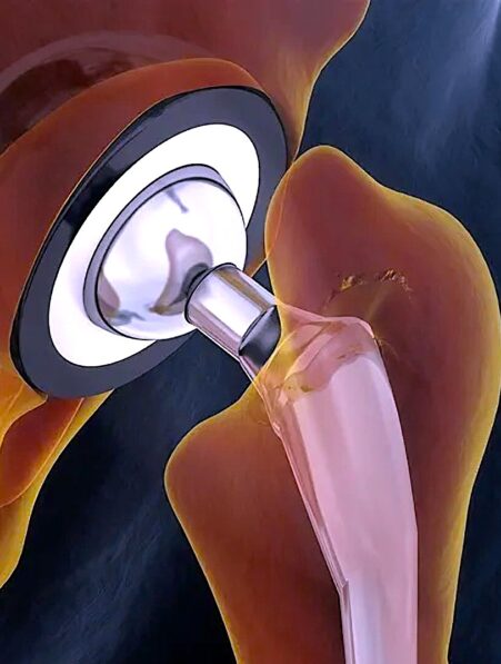 alliage metallique flexible resistant implants durables