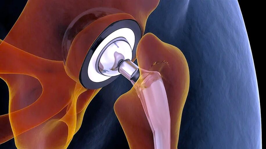 alliage metallique flexible resistant implants durables