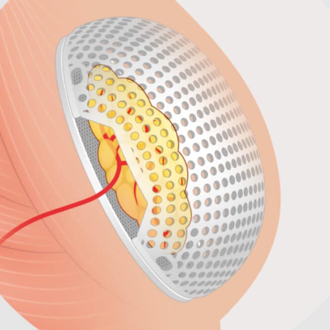 implant mammaire résorbable