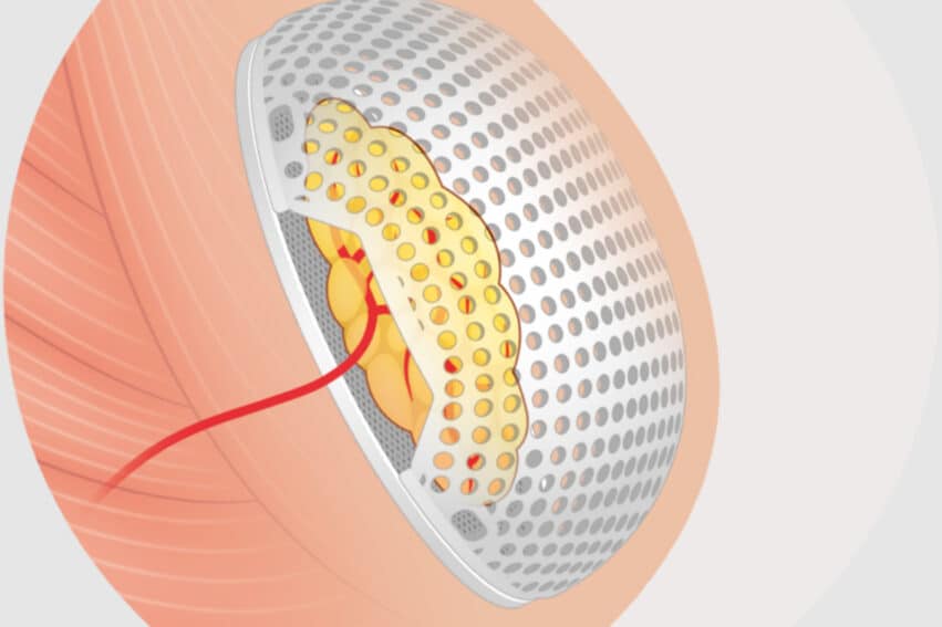 implant mammaire résorbable