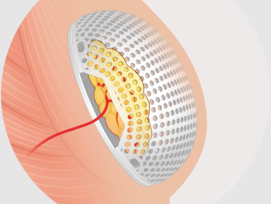 implant mammaire résorbable