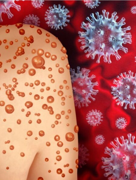 variole singe urgence sanitaire internationale transmission sexuelle couv
