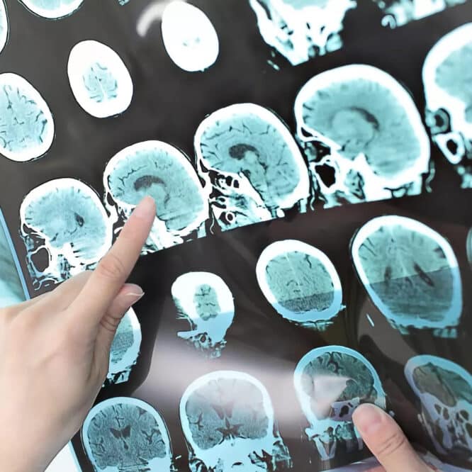 médicament alzheimer déclin cognitif