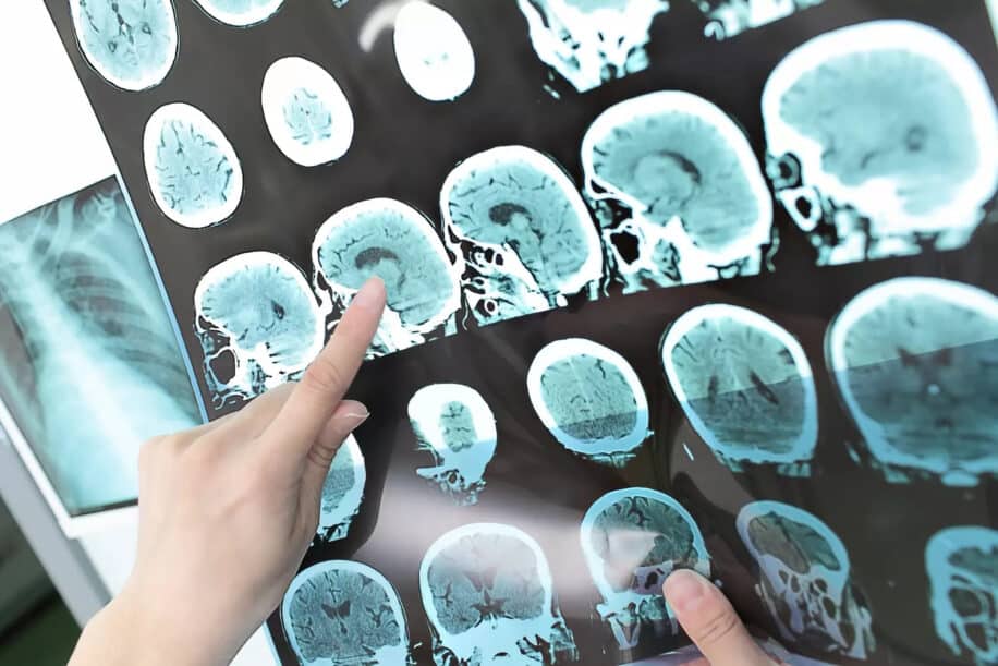 médicament alzheimer déclin cognitif