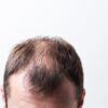nouveau traitement calvitie alopecie molecule pousse cheveux couv