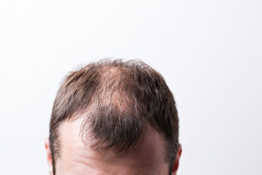 nouveau traitement calvitie alopecie molecule pousse cheveux couv