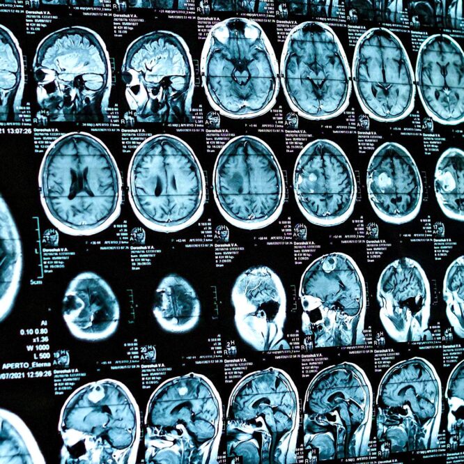 COVID impact cerveau adolescents