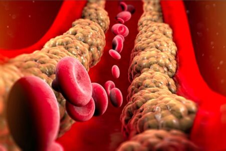 medicament combattre mauvais cholesterol genetique couv
