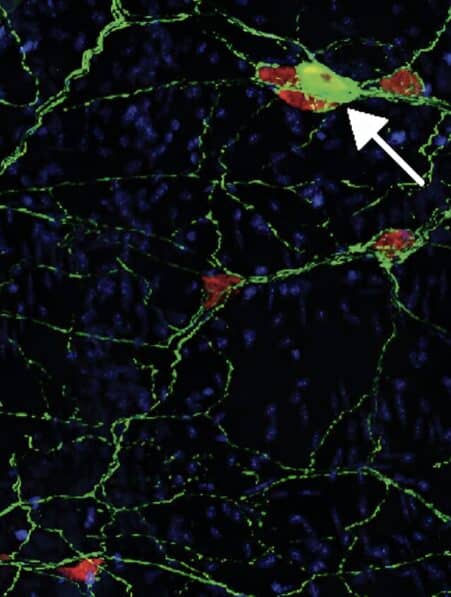 parkinson intestin auto immunite