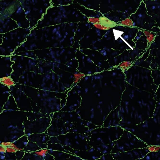 parkinson intestin auto immunite