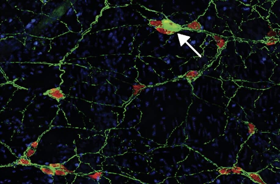 parkinson intestin auto immunite