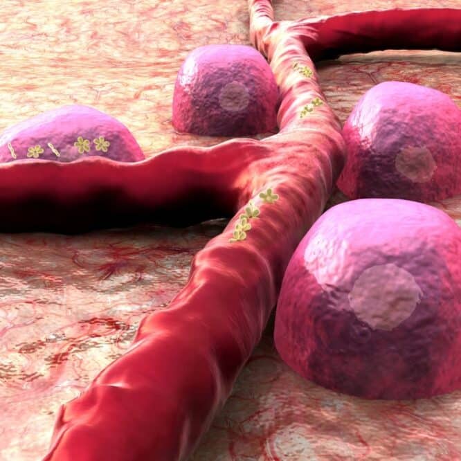 diabete type 1 pancreatique