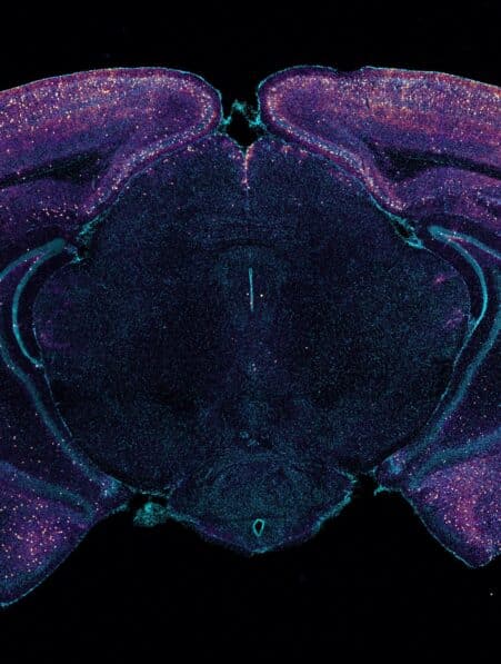 alzheimer sensorielle detoxifiant