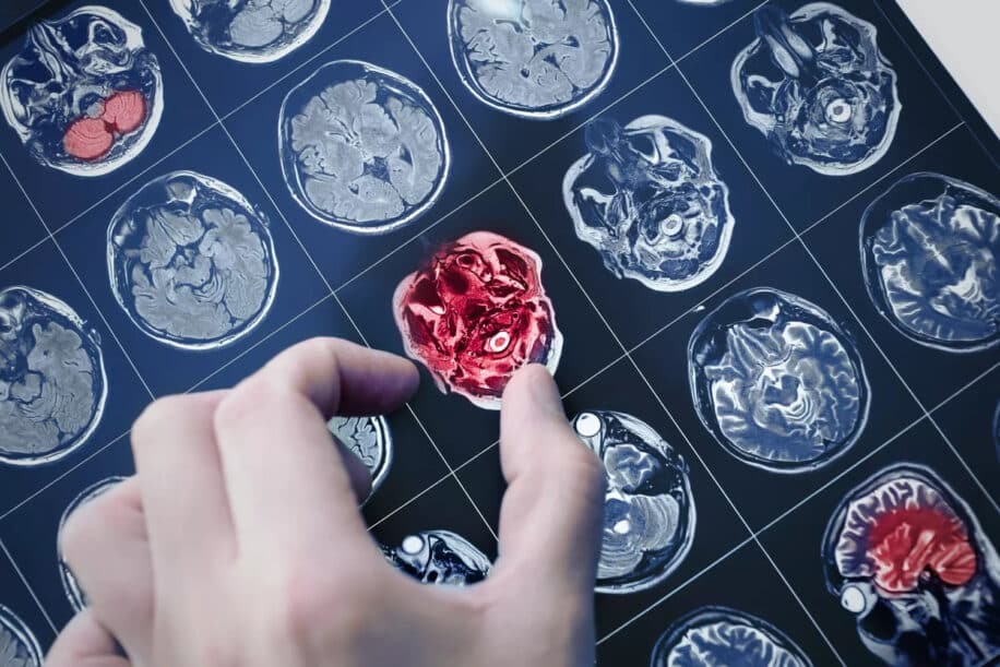 cancer cerveau enfant