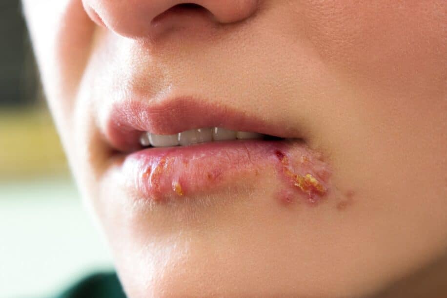 herpes demence double