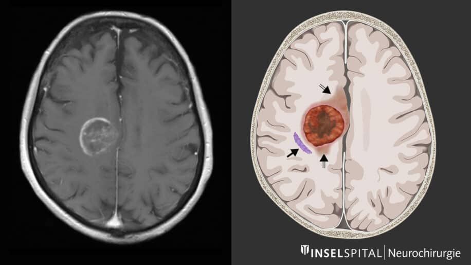 therapie carT glioblastome