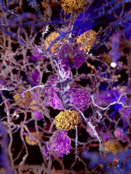 Alzheimer un nouveau traitement contre la maladie rétrécit le cerveau mais cela pourrait être une bonne chose selon une nouvelle étude